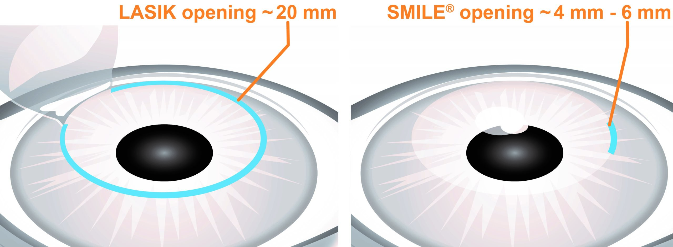 SMILE vs LASIK Eye Surgery