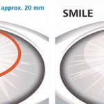 SMILE EYE SURGERY VS LASIK