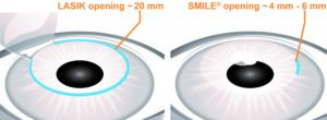 LASIK-&-Zeiss-SMILE-Side-by-Side-Graphic