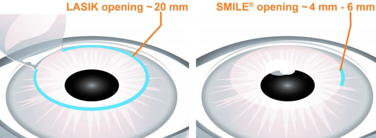 LASIK-vs-SMILE-Side-by-Side-Graphic