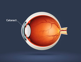 Cataract Surgery Illustration
