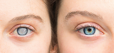 Cataract Comparison Eyes