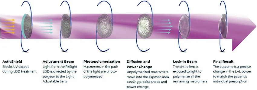 Light Adjustable Lenses